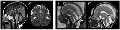 Neuroimaging features of WOREE syndrome: a mini-review of the literature